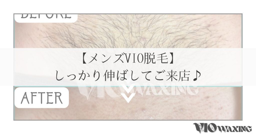 松山メンズ脱毛