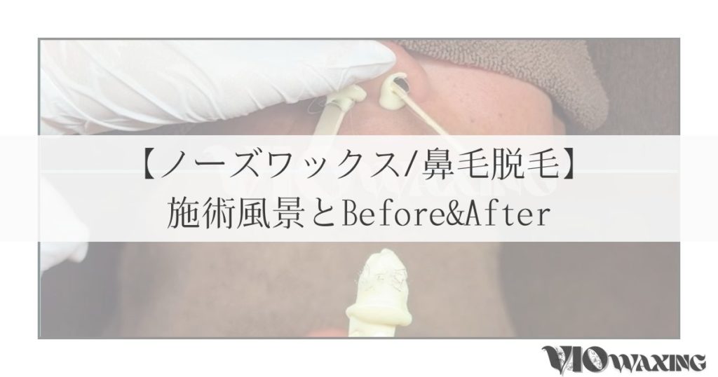 ノーズワックス 鼻毛 脱毛 メンズ脱毛 身だしなみ