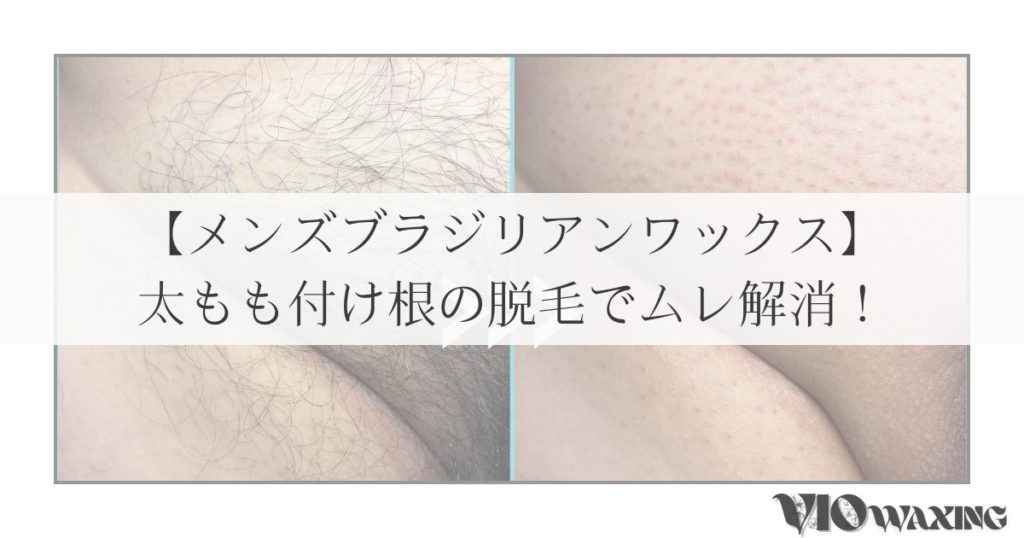メンズワックス脱毛 メンズ脱毛 VIO