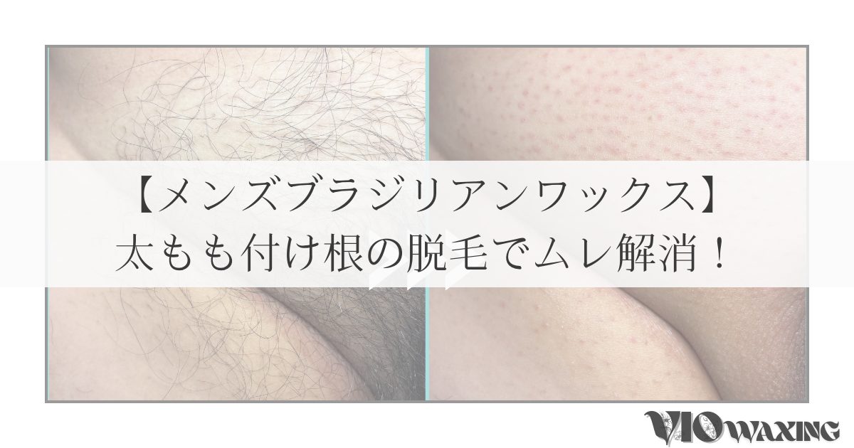 メンズワックス脱毛 メンズ脱毛 VIO