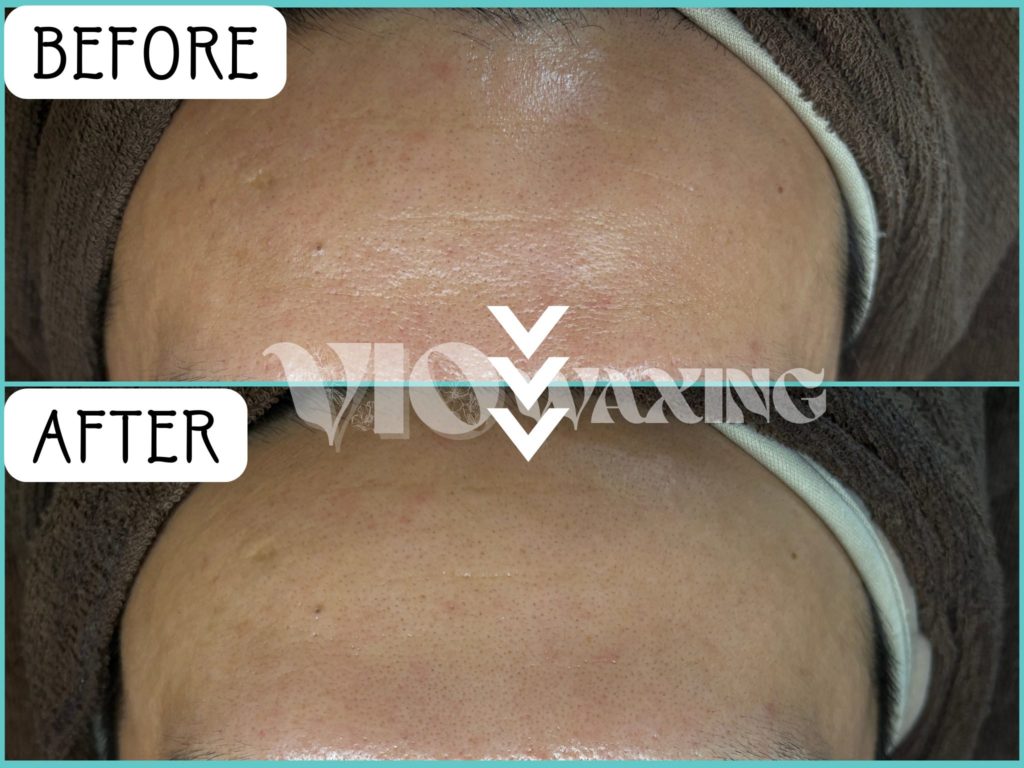 メンズフェイシャル エステサロン ほうれい線 しわ 男性