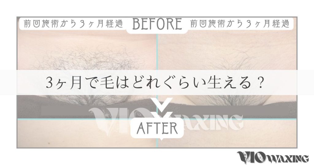 ブラジリアンワックス vio脱毛 ワックス脱毛 松山市 愛媛