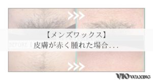 ブラジリアンワックス vio ワックス脱毛 男性 お腹 へそ 松山市 愛媛 ギャランドゥ