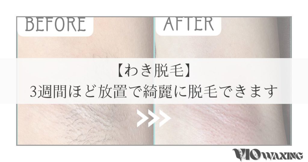 両脇 わき 脱毛 ワックス脱毛 ブラジリアンワックス