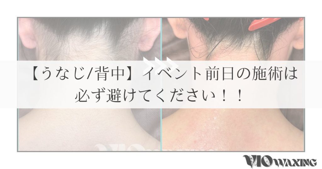 うなじ 背中 ワックス 耳の後ろ 脱毛 松山市 成人式 準備 結婚式 赤み