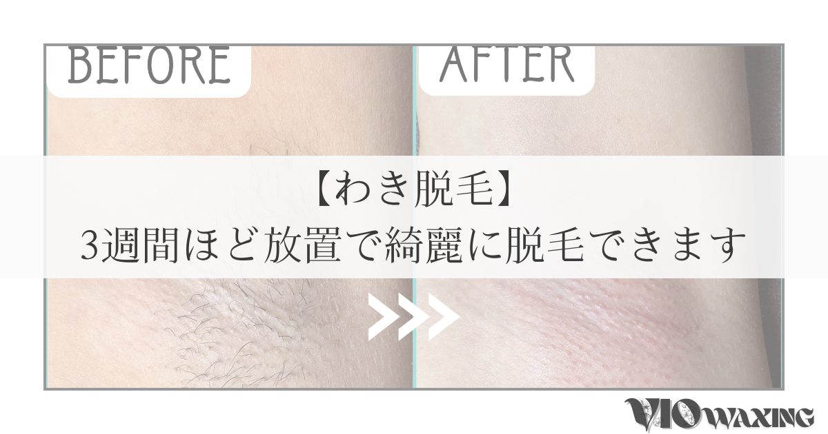 両脇 わき 脱毛 ワックス脱毛 ブラジリアンワックス