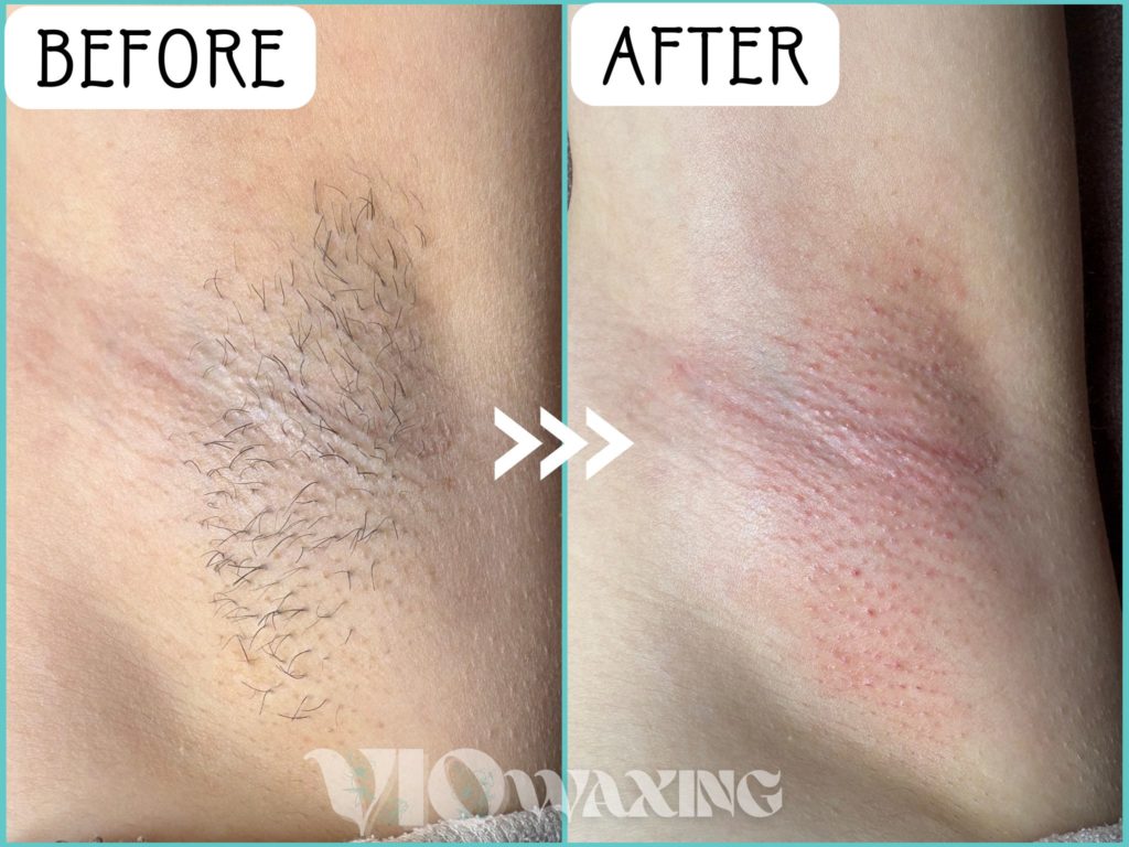 両脇 わき 脱毛 ワックス脱毛 ブラジリアンワックス